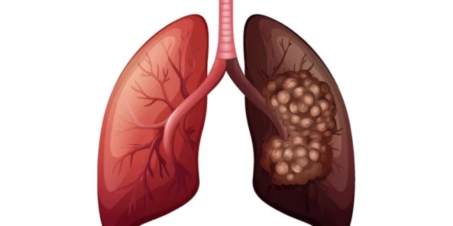 ابتكار لقاح ضد سرطان الرئة؟